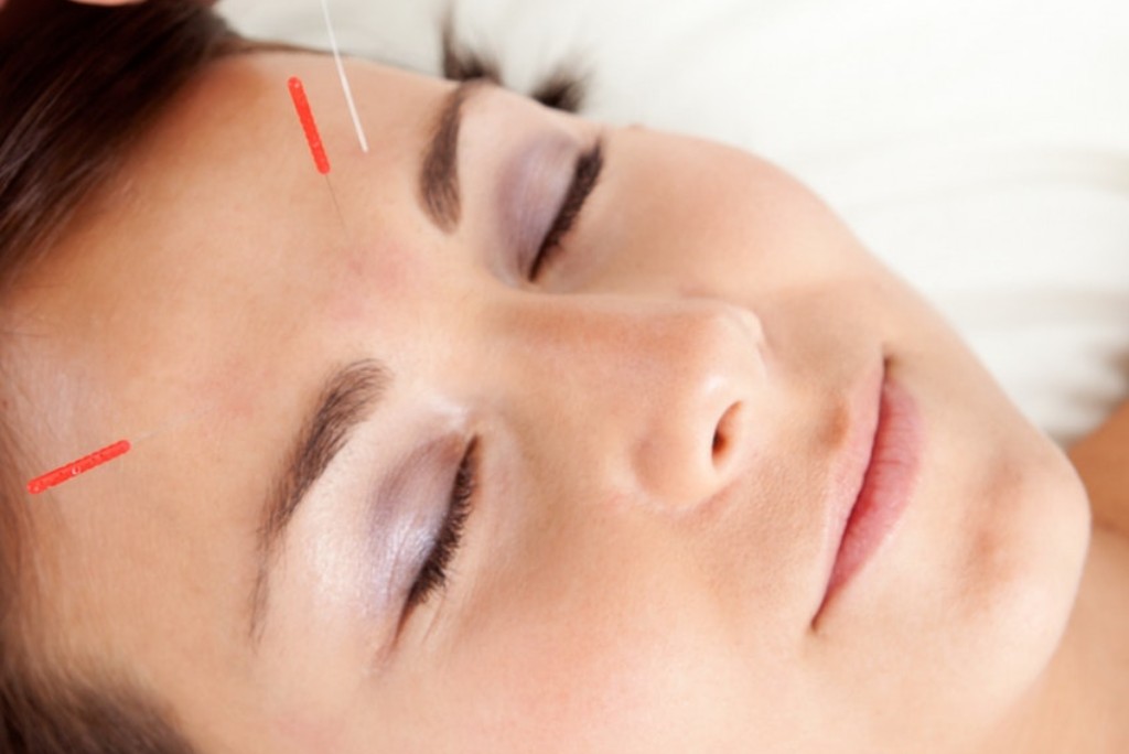 Cosmetic Acupuncture Sage Naturopathic Clinic 